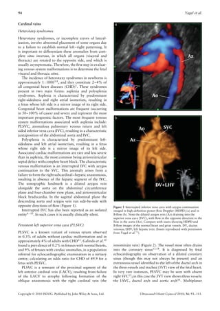94                                                                                                                    Yagel et al.


Cardinal veins
Heterotaxy syndromes
Heterotaxy syndromes, or incomplete errors of lateral-
ization, involve abnormal placement of some organs due
to a failure to establish normal left–right patterning. It
is important to differentiate these anomalies from com-
plete situs inversus, in which all organs (visceral and
thoracic) are rotated to the opposite side, and which is
usually asymptomatic. Therefore, the ﬁrst step in evaluat-
ing venous system malformations is to determine the fetal
visceral and thoracic situs.
   The incidence of heterotaxy syndromes in newborns is
approximately 1 : 10003,4 , and they constitute 2–4% of
all congenital heart diseases (CHD)5 . These syndromes
present in two main forms: asplenia and polysplenia
syndromes. Asplenia is characterized by predominant
right-sidedness and right atrial isomerism, resulting in
a fetus whose left side is a mirror image of its right side.
Congenital heart malformations are frequent (occurring
in 50–100% of cases) and severe and represent the most
important prognostic factors. The most frequent venous
system malformations associated with asplenia include:
PLSVC, anomalous pulmonary venous return and left
sided inferior vena cava (IVC), resulting in a characteristic
juxtaposition of the abdominal aorta and IVC.
   Polysplenia is characterized by predominant left-
sidedness and left atrial isomerism, resulting in a fetus
whose right side is a mirror image of its left side.
Associated cardiac malformations are rare and less severe
than in asplenia, the most common being atrioventricular
septal defect with complete heart block. The characteristic
venous malformation is an interrupted IVC with azygos
continuation to the SVC. This anomaly arises from a
failure to form the right subcardinal–hepatic anastomosis,
resulting in absence of the hepatic segment of the IVC.
The sonographic landmark is a dilated azygos vein
alongside the aorta on the abdominal circumference
plane and four-chamber view plane, and atrioventricular
block bradycardia. In the sagittal abdominal plane the
descending aorta and azygos vein run side-by-side with
opposite directions of ﬂow (Figure 1).                          Figure 1 Interrupted inferior vena cava with azygos continuation
   Interrupted IVC has also been reported as an isolated        imaged in high-deﬁnition power ﬂow Doppler (HDPD) (a) and in
entity6 – 10 . In such cases it is usually clinically silent.   B-ﬂow (b). Note the dilated azygos vein (Az) draining into the
                                                                superior vena cava (SVC), with ﬂow in the opposite direction to the
                                                                ﬂow in the aorta (Ao). Compare with insets showing HDPD and
Persistent left superior vena cava (PLSVC)                      B-ﬂow images of the normal heart and great vessels. DV, ductus
                                                                venosus; LHV, left hepatic vein. (Insets reproduced with permission
PLSVC is a known variant of venous return observed              from Yagel et al.75 ).
in 0.3% of adults without cardiac malformation and in
approximately 4% of adults with CHD11 . Galindo et al.12
found a prevalence of 0.2% in fetuses with normal hearts,       innominate vein) (Figure 2). The vessel most often drains
and 9% of fetuses with cardiac anomalies, in a population       into the coronary sinus13,14 . It is diagnosed by fetal
referred for echocardiographic examination in a tertiary        echocardiography on observation of a dilated coronary
center, calculating an odds ratio for CHD of 49.9 for a         sinus (though this may not always be present) and an
fetus with PLSVC.                                               extraneous vessel identiﬁed to the left of the ductal arch in
   PLSVC is a remnant of the proximal segment of the            the three-vessels and trachea (3VT) view of the fetal heart.
left anterior cardinal vein (LACV), resulting from failure      In very rare instances, PLSVC may be seen with absent
of the LACV to atrophy following formation of the               right SVC15 ; in this case the 3VT view shows three vessels:
oblique anastomosis with the right cardinal vein (the           the LSVC, ductal arch and aortic arch16 . Multiplanar


Copyright  2010 ISUOG. Published by John Wiley & Sons, Ltd.                       Ultrasound Obstet Gynecol 2010; 36: 93–111.
 