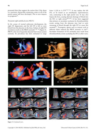 96                                                                                                             Yagel et al.


presented data that support the notion that if the shunt       from 1 : 250 to 1 : 57037,39 – 42 . It may replace the left
is a narrower, ductus-like connection, some or all of the      UV, or be found as an intrahepatic supernumerary
portal system will have developed. This in turn impacts        vein, connecting to the right portal vein. It may also
on prognosis35 .                                               bypass the liver, causing aberrant drainage of blood into
                                                               the IVC or right atrium40,43,44 . It has been suggested
Persistent right umbilical vein (PRUV)                         that primary or secondary occlusion by thromboembolic
                                                               events arising from the placenta may lead to early
In the course of normal embryonic development, the
right UV degenerates and the left UV is left to carry          streaming of blood through the right UV to cause this
blood from the placenta to the fetus. Failure of right UV      anomaly45 . Teratogenic agents such as retinoic acid or
involution results in the PRUV anomaly1,36 – 39 (Figure 4).    deﬁcient folate induced the PRUV anomaly in rats46 .
PRUV is the most frequently detected fetal venous system       Secondary formation of UV anomalies may result from
anomaly. Its prevalence has been estimated to range            thromboembolic events occluding the DV or other veins.




Figure 3 (Continued over).



Copyright  2010 ISUOG. Published by John Wiley & Sons, Ltd.                    Ultrasound Obstet Gynecol 2010; 36: 93–111.
 