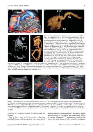The fetal venous system, Part II                                                                                                           97




                                                                Figure 3 (Continued) Variations of agenesis of the ductus venosus (DV).
                                                                (a–c) Case of agenesis of the DV with narrow extrahepatic shunt from the
                                                                umbilical vein (UV) to the inferior vena cava (IVC), imaged with high-
                                                                definition power flow Doppler (HDPD) (a,c) and B-flow (b). In (c) the
                                                                appropriately developed portal system is shown. (Az, azygos vein; LHV,
                                                                left hepatic vein; LPV, left portal vein; MHV, main hepatic vein; RPVa and
                                                                p, anterior and posterior branches of right portal vein; St, stomach.) (d–g)
                                                                Complex case of agenesis of the DV with extrahepatic shunt, complicated
                                                                with interrupted IVC. (d) HDPD image showing the UV draining into the
                                                                shunt, between the IVC and Az. Note the Az is behind the aorta (red)
                                                                Int-I, internal iliac vein. (e) B-flow image which helps to demonstrate the
                                                                interrupted IVC with Az continuation, and the point of communication
                                                                of the UV to the IVC at this connection. Note that there are almost no
                                                                blood vessels in the area of the liver, which further suggests agenesis of
                                                                the portal system. (f,g) Tomographic ultrasound imaging showing
                                                                sequential sagittal planes, confirming the agenesis of the DV and inter-
                                                                rupted IVC. The image in (f) is slightly lateral to the left of that in (g).
                                                                AoA, aortic arch; dAo, descending aorta; Az, azygos; CT, celiac trunk;
DA, ductus arteriosus; MPA, main pulmonary artery. (h,i) Another case of agenesis of the DV with intrahepatic shunt of the UV to the right
hepatic vein (RHV), imaged in HDPD and B-flow. (j) 4D ultrasound B-flow image of absent DV, with UV drainage to the right atrium (RA).
Ao, aorta; HV, hepatic veins; UC, umbilical cord. (Reproduced with permission from Yagel et al.134.) (k) Agenesis of the DV with partial
agenesis of the portal system. Inversion mode in three-dimensional rendering demonstrating the umbilicoiliac shunt (carets). UA, umbilical
artery. (Reproduced with permission from Achiron et al.55).




Figure 4 Typical appearance of persistent right umbilical vein (UV). (a) The UV is seen passing laterally right of the gall bladder (GB).
(b) The portal vein presents a mirror image of its normal anatomical conﬁguration. The left portal vein (LPV) assumes the right portal vein
(RPV) bifurcation, and its lateral branches change sides, the right side having the inferior (LPVi) and superior (LPVs) branches, and the left
side having only one lateral branch. The ductus venosus (DV) has its origin to the left of the UV axis. (c) The main portal vein (MPV) is
connected to the RPV in a more inferior plane relative to its normal position. LPVm, left portal vein medial branch; ST, stomach; SP, spine;
Ao, aorta.


Echogenic foci situated within the fetal liver suggest this               with multiple associated anomalies47 . While early reports
etiology.                                                                 seemed to indicate that PRUV was a worrisome ﬁnding
   Two of the 74 cases of PRUV reviewed by De Catte                       in prenatal ultrasound43,45 , accumulated experience has
et al. had Noonan syndrome, and one had trisomy 18, all                   shown that in the absence of other anomalies intrahepatic


Copyright  2010 ISUOG. Published by John Wiley & Sons, Ltd.                                  Ultrasound Obstet Gynecol 2010; 36: 93–111.
 