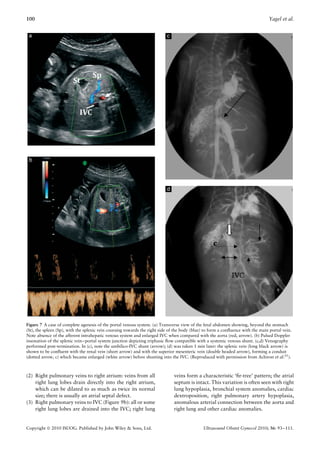 100                                                                                                                              Yagel et al.




Figure 7 A case of complete agenesis of the portal venous system. (a) Transverse view of the fetal abdomen showing, beyond the stomach
(St), the spleen (Sp), with the splenic vein coursing towards the right side of the body (blue) to form a conﬂuence with the main portal vein.
Note absence of the afferent intrahepatic venous system and enlarged IVC when compared with the aorta (red, arrow). (b) Pulsed Doppler
insonation of the splenic vein–portal system junction depicting triphasic ﬂow compatible with a systemic venous shunt. (c,d) Venography
performed post-termination. In (c), note the umbilico-IVC shunt (arrow); (d) was taken 1 min later: the splenic vein (long black arrow) is
shown to be conﬂuent with the renal vein (short arrow) and with the superior mesenteric vein (double headed arrow), forming a conduit
(dotted arrow, c) which became enlarged (white arrow) before shunting into the IVC. (Reproduced with permission from Achiron et al.55 ).



(2) Right pulmonary veins to right atrium: veins from all                      veins form a characteristic ‘ﬁr-tree’ pattern; the atrial
    right lung lobes drain directly into the right atrium,                     septum is intact. This variation is often seen with right
    which can be dilated to as much as twice its normal                        lung hypoplasia, bronchial system anomalies, cardiac
    size; there is usually an atrial septal defect.                            dextroposition, right pulmonary artery hypoplasia,
(3) Right pulmonary veins to IVC (Figure 9b): all or some                      anomalous arterial connection between the aorta and
    right lung lobes are drained into the IVC; right lung                      right lung and other cardiac anomalies.


Copyright  2010 ISUOG. Published by John Wiley & Sons, Ltd.                                  Ultrasound Obstet Gynecol 2010; 36: 93–111.
 