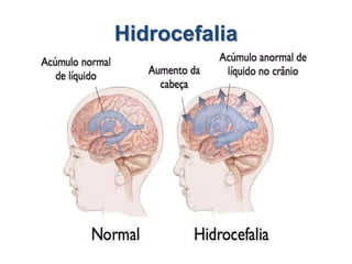 Hidrocefalia