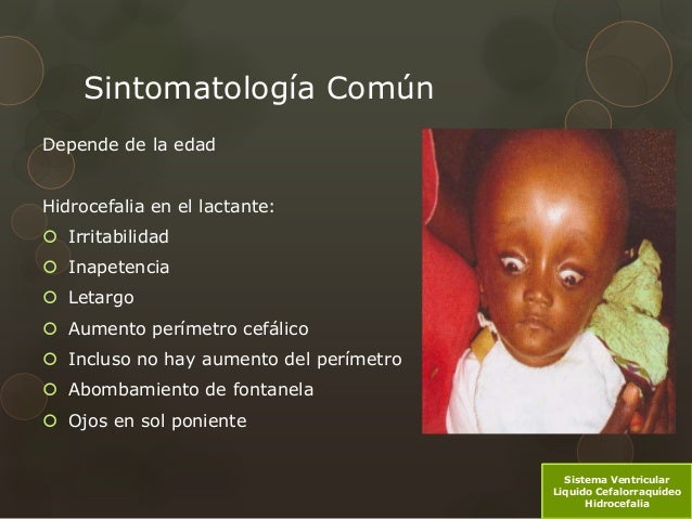 Sistema Ventricular, Liquido Cefalorraquideo LCR, Hidrocefalia
