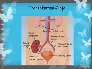 Transplantasi Ginjal
 