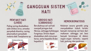 GANGGUAN SISTEM
HATI
PENYAKIT HATI
(LIVER)
SIROSIS HATI
(CIRRHOSIS) HEMOKROMATOSIS
Paling sering disebabkan
oleh infeksi virus, amoeba
penyebab disentry, cacing,
plasmodium penyebab
malaria dab Toxoplasma sp.
Berubahnya sel-sel hati
menjadi jaringan ikat
fibrosa, sehingga kehilangan
fungsinya. Sirosis dapat
disebabkan oleh minuman
keras, serta hepatitis B dan
hepatitis C
Kelainan secara genetik yang
menyebabkan tubuh terlalu
banyak menyerap zat besi dari
makanan sehingga zat besi
banyak tersimpan di dalam
organ-organ tertentu, seperti
hati, jantung, dan pankreas.
 