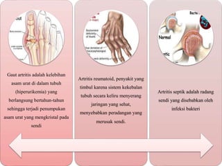 Gaut artritis adalah kelebihan
asam urat di dalam tubuh
(hiperurikemia) yang
berlangsung bertahun-tahun
sehingga terjadi penumpukan
asam urat yang mengkristal pada
sendi
Artritis reumatoid, penyakit yang
timbul karena sistem kekebalan
tubuh secara keliru menyerang
jaringan yang sehat,
menyebabkan peradangan yang
merusak sendi.
Artritis septik adalah radang
sendi yang disebabkan oleh
infeksi bakteri
 