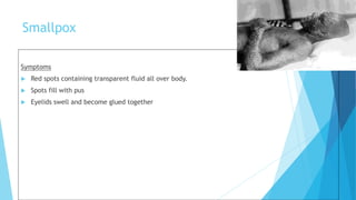 Smallpox
Symptoms
 Red spots containing transparent fluid all over body.
 Spots fill with pus
 Eyelids swell and become glued together
 