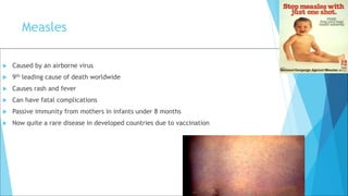 Measles
 Caused by an airborne virus
 9th leading cause of death worldwide
 Causes rash and fever
 Can have fatal complications
 Passive immunity from mothers in infants under 8 months
 Now quite a rare disease in developed countries due to vaccination
 
