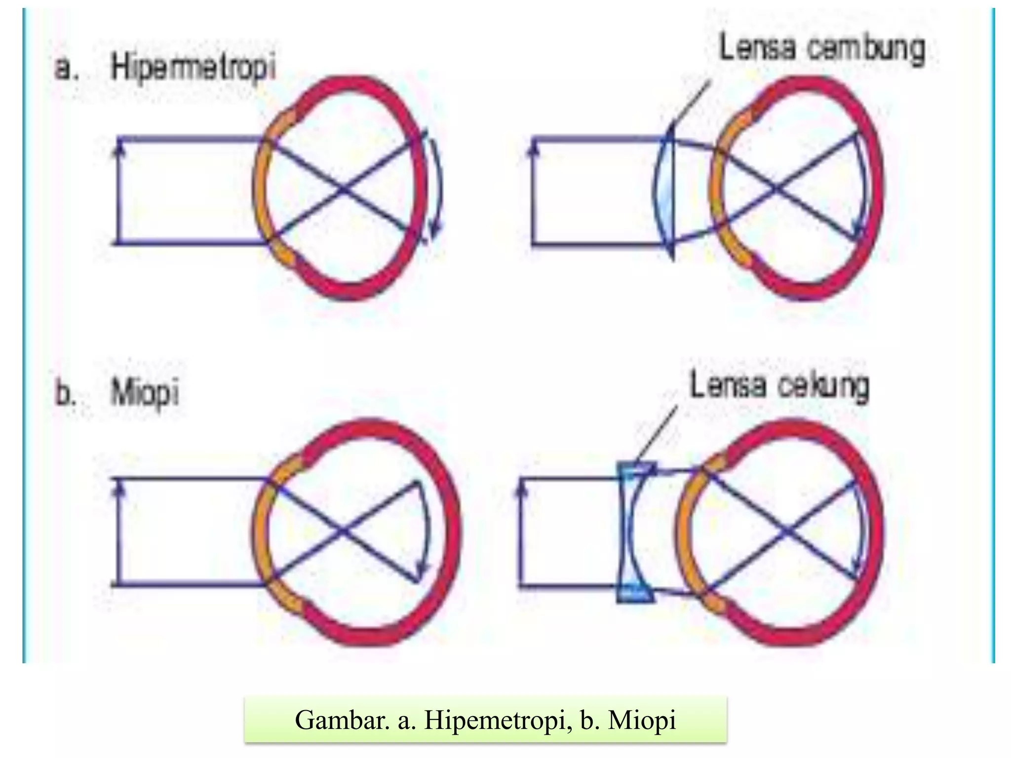 Gambar. a. Hipemetropi, b. Miopi
 