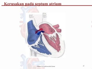 Kerusakan pada septum atrium
22
Chapter 18, Cardiovascular System
 