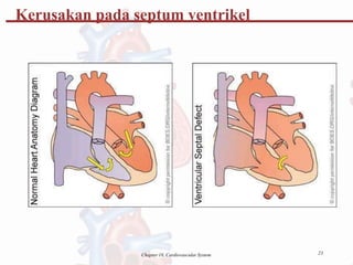 Kerusakan pada septum ventrikel
23
Chapter 18, Cardiovascular System
 