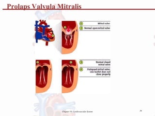 Prolaps Valvula Mitralis
36
Chapter 18, Cardiovascular System
 