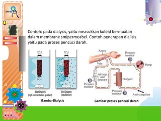 d. Ke
Contoh: pada dialysis, yaitu measukkan koloid bermuatan
dalam membrane smipermeabel. Contoh penerapan dialisis
yaitu pada proses pencuci darah.
GambarDialysis Gambar proses pencuci darah
 