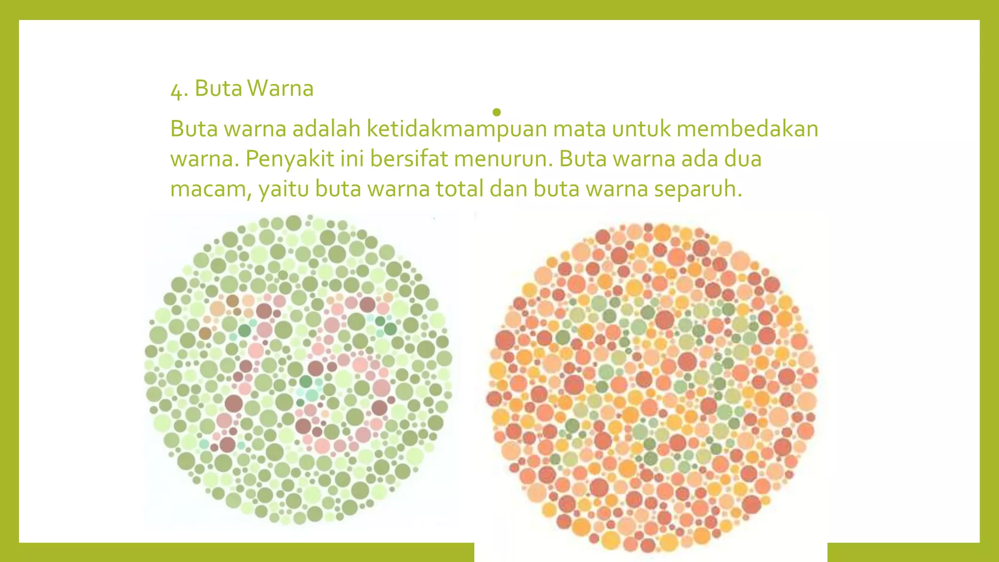 •
4. ButaWarna
Buta warna adalah ketidakmampuan mata untuk membedakan
warna. Penyakit ini bersifat menurun. Buta warna ada dua
macam, yaitu buta warna total dan buta warna separuh.
 