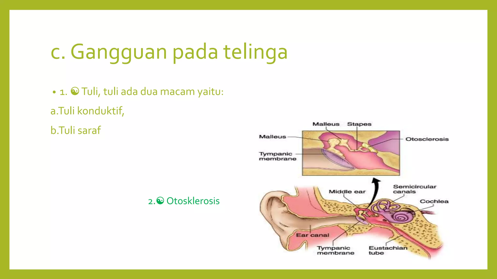 c. Gangguan pada telinga
• 1. ☯Tuli, tuli ada dua macam yaitu:
a.Tuli konduktif,
b.Tuli saraf
2.☯ Otosklerosis
 
