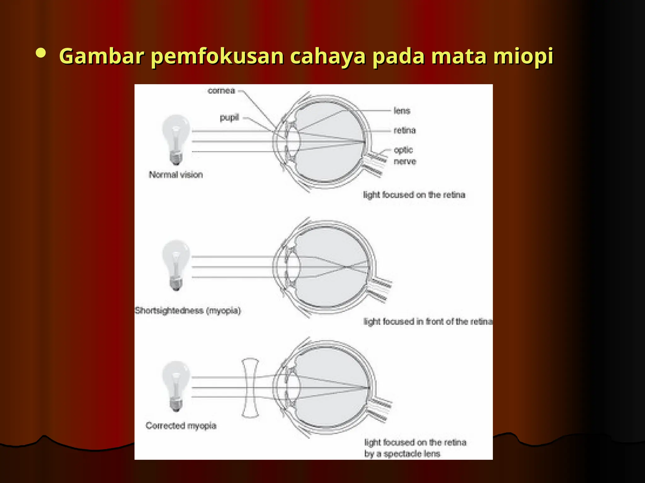  Gambar pemfokusan cahaya pada mata miopi
Gambar pemfokusan cahaya pada mata miopi
 