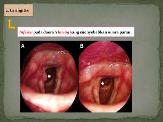 2. Laringitis




       Infeksi pada daerah laring yang menyebabkan suara parau.
 