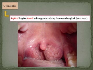 3. Tonsilitis




        Infeksi bagian tonsil sehingga meradang dan membengkak (amandel).
 