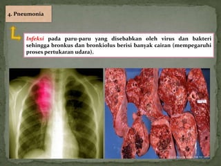 4. Pneumonia



      Infeksi pada paru-paru yang disebabkan oleh virus dan bakteri
      sehingga bronkus dan bronkiolus berisi banyak cairan (mempegaruhi
      proses pertukaran udara).
 