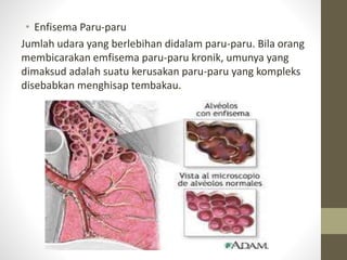 • Enfisema Paru-paru
Jumlah udara yang berlebihan didalam paru-paru. Bila orang
membicarakan emfisema paru-paru kronik, umunya yang
dimaksud adalah suatu kerusakan paru-paru yang kompleks
disebabkan menghisap tembakau.
 