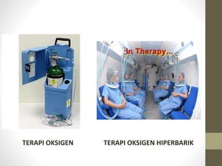 TERAPI OKSIGEN TERAPI OKSIGEN HIPERBARIK
 