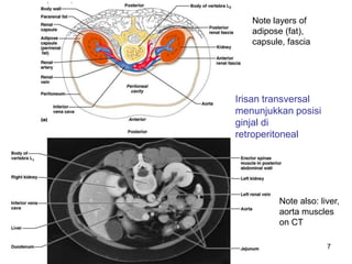 7
Irisan transversal
menunjukkan posisi
ginjal di
retroperitoneal
Note also: liver,
aorta muscles
on CT
Note layers of
adipose (fat),
capsule, fascia
 