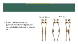 Orang Rakitis Sistem Tulang Sistem Tulang Sistem Tulang | PPTX