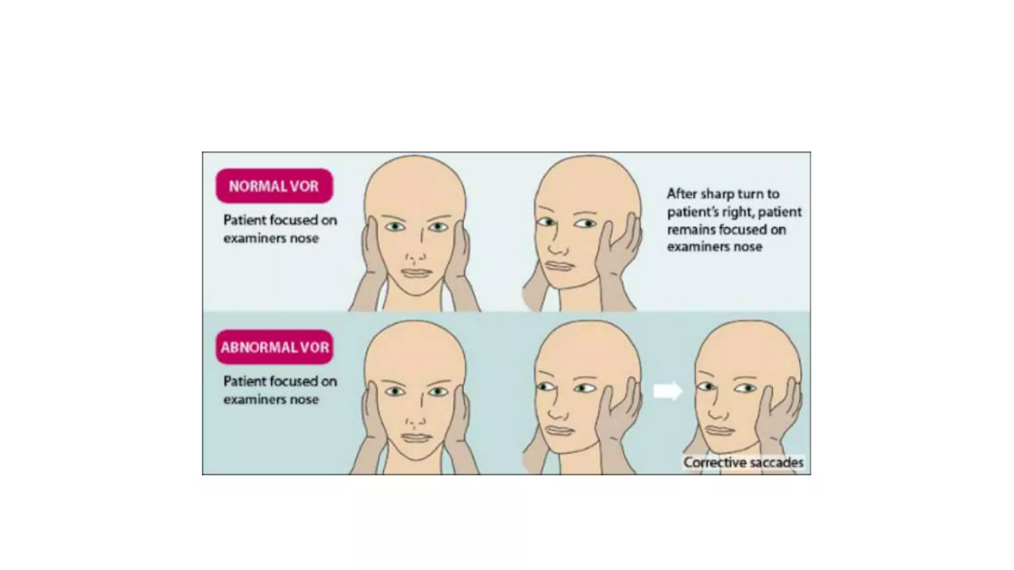 Sistem Vestibular.pptx