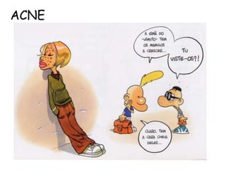 ACNE