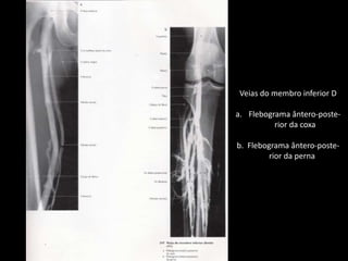Veias do membro inferior DFlebogramaântero-poste-rior da coxab.  Flebogramaântero-poste-rior da perna 