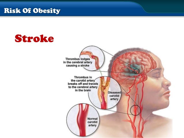 How much weight to lose for tummy tuck image 4