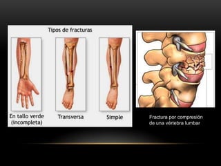 Fractura por compresión
de una vértebra lumbar
 