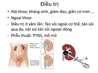 Điều trị
• Nội khoa: kháng sinh, giảm đau, giãn cơ trơn ...
• Ngoại khoa:
- Điều trị ít xâm lấn: Tán sỏi ngoài cơ thể, tán sỏi
qua da, nội soi tán sỏi ngược dòng
- Phẫu thuật: PTNS, mổ mở
 