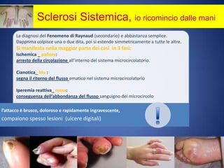 		    Sclerosi Sistemica, io ricomincio dalle maniLa diagnosi del Fenomeno di Raynaud(secondario) e abbastanza semplice.Dapprima colpisce una o due dita, poi si estende simmetricamente a tutte le altre. Si manifesta nella maggior parte dei casi  in 3 fasi:Ischemica _ pallore: arresto della circolazioneall’interno del sistema microcircolatorio.Cianotica_blu :segna il ritorno del flusso ematico nel sistema microcircolatorioIperemia reattiva_rossa:conseguenza dell’abbondanza del flussosanguigno del microcircolo     !