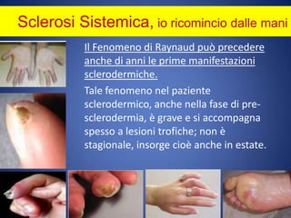 Sclerosi Sistemica, io ricomincio dalle maniIl Fenomeno di Raynaud può precedere anche di anni le prime manifestazioni sclerodermiche. 	Tale fenomeno nel paziente sclerodermico, anche nella fase di pre-sclerodermia, è grave e si accompagna spesso a lesioni trofiche; non è stagionale, insorge cioè anche in estate.