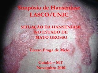 Simpósio de Hanseníase
LASCO/UNIC
SITUAÇÃO DA HANSENÍASE
NO ESTADO DE
MATO GROSSO
Cícero Fraga de Melo
Cuiabá – MT
Novembro 2010
 