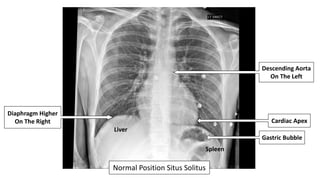 Healthy 42-
Year-Old Has
An Incidental
Finding On
Chest X-Ray
 