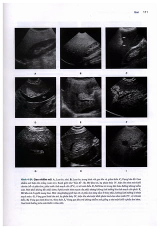Siêu âm chẩn đoán