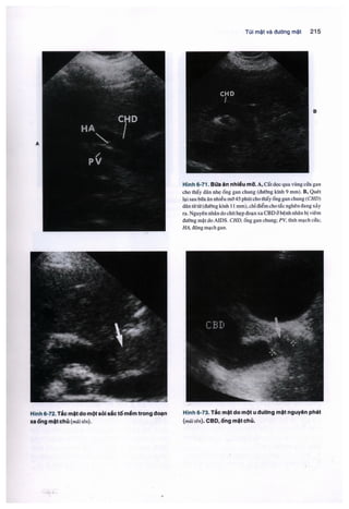 Siêu âm chẩn đoán