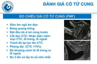  Siêu âm ngư âm đạo
 Bàng quang trống
 Đặt đ u dò ở túi cùng tr c
 Cắt dọc CTC: Nh n diện niêm
mạc CTC, lỗ trong, lỗ ngoài
 Tránh đè áp lực lên CTC
 Phóng đại (CTC >75%)
 Đo khoảng cách t lỗ trong ra
lỗ ngoài
 Đo 3 l n và lấy trị số nhỏ nhất
ĐÁNH GIÁ C T CUNG
ĐO CHI U DẨI C T CUNG (FMF)
 