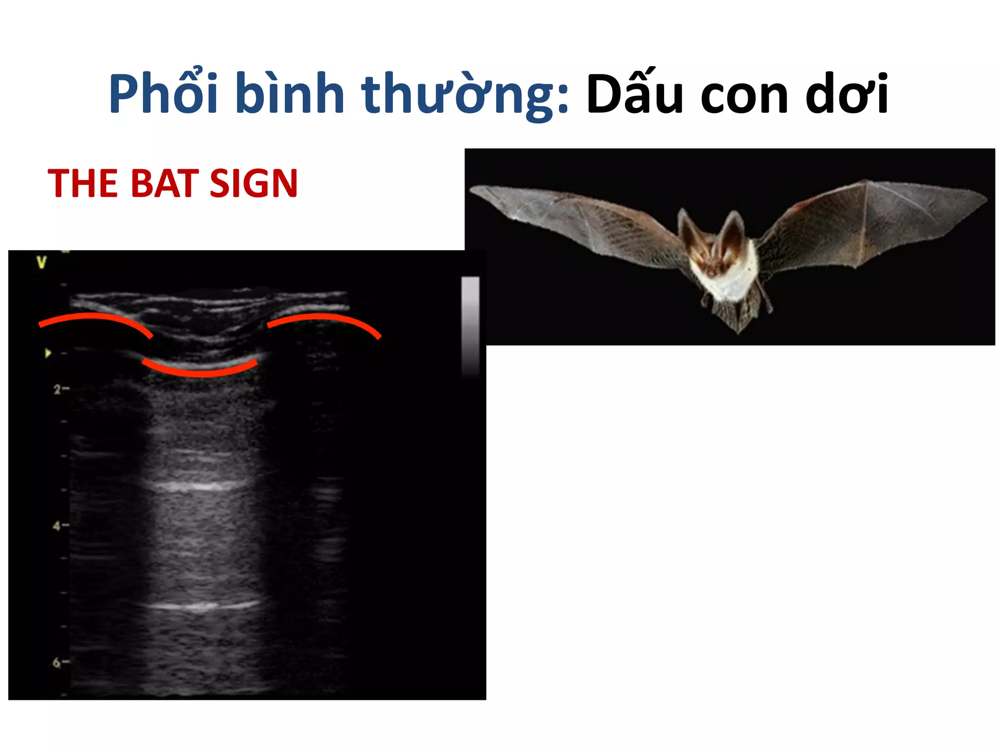 Phổi bình thường: Dấu con dơi
THE BAT SIGN
 