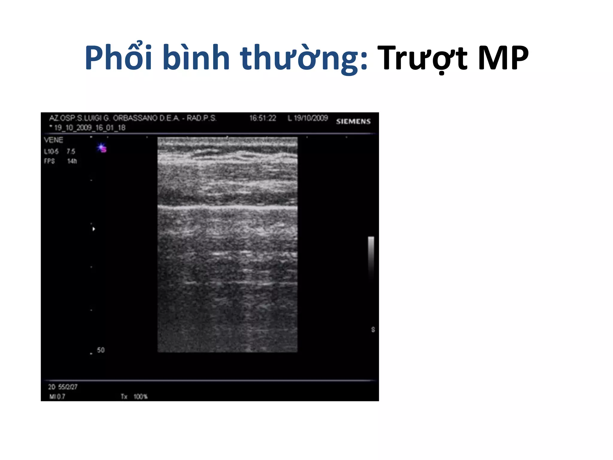Phổi bình thường: Trượt MP
 