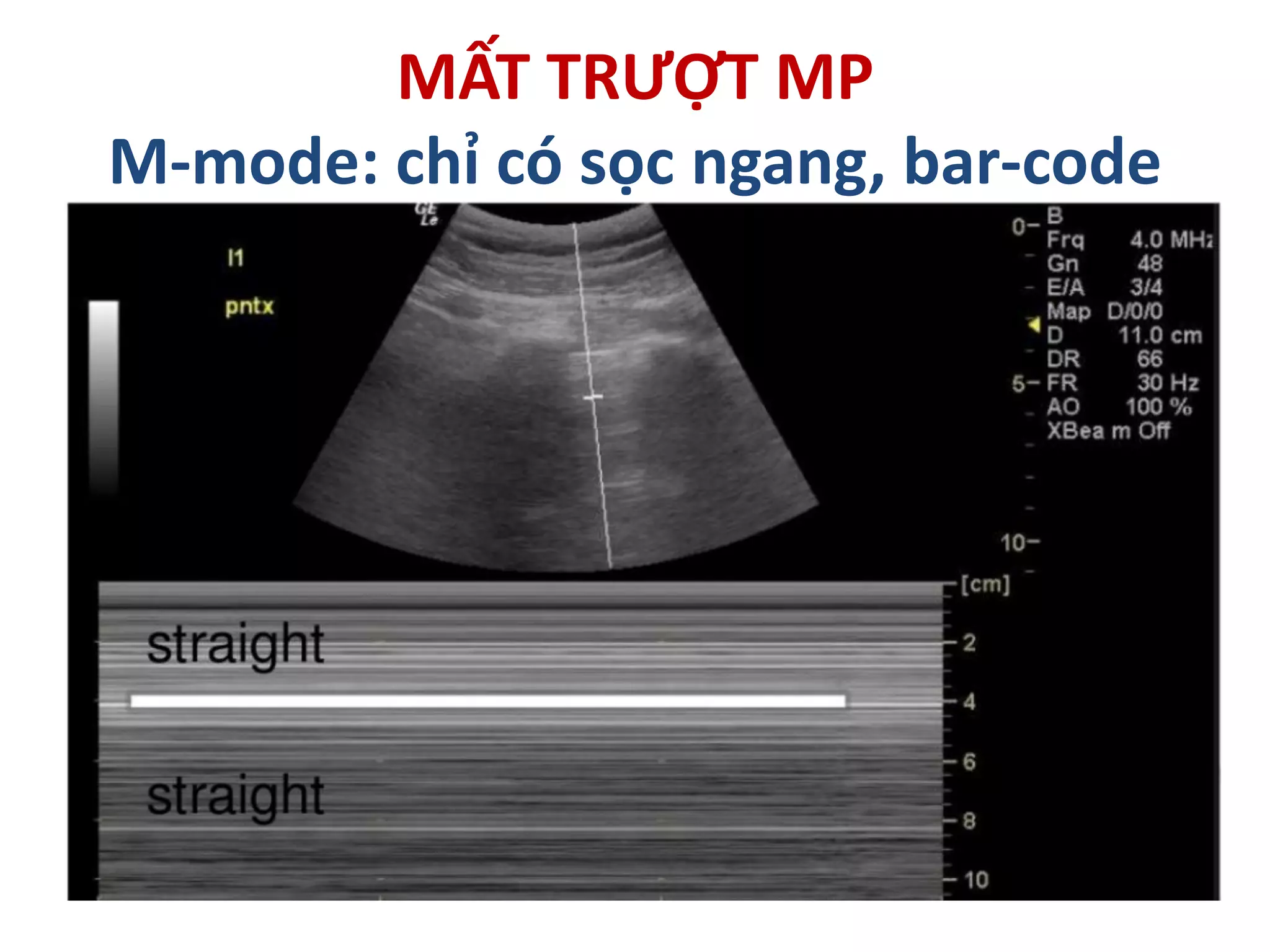 MẤT TRƯỢT MP
M-mode: chỉ có sọc ngang, bar-code
 