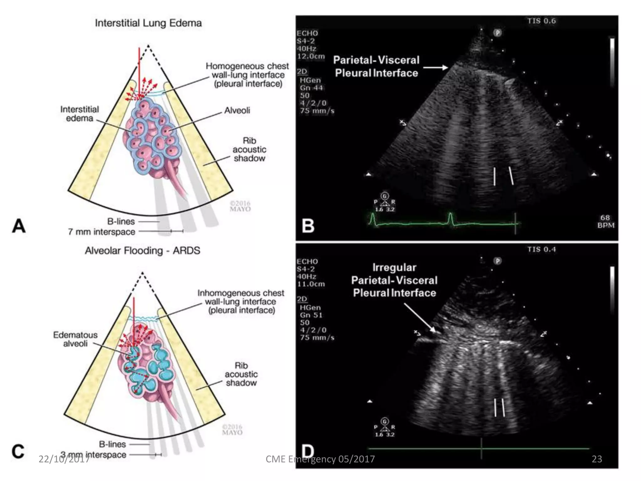 22/10/2017 CME Emergency 05/2017 23
 