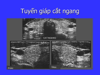 Tuyến giáp cắt ngang
 