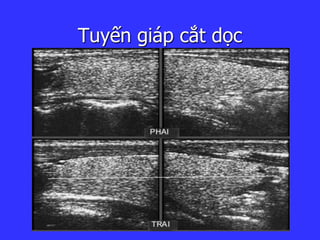 Tuyến giáp cắt ọc
 