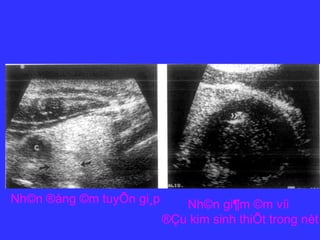 Nh©n ®ång ©m tuyÕn gi¸p Nh©n gi¶m ©m víi
®Çu kim sinh thiÕt trong nèt
 