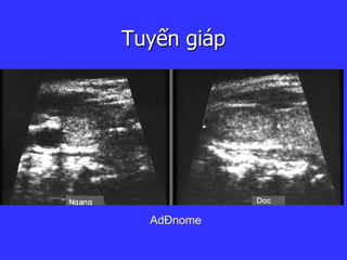 Tuyến giáp
AdÐnome
 