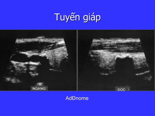 Tuyến giáp
AdÐnome
 