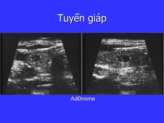 Tuyến giáp
AdÐnome
 
