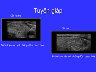 Tuyến giáp
Bướu loạn sản với những đốm canxi hóa
Cắt ngang
Bướu loạn sản với những đốm canxi hóa
Cắt ọc
 